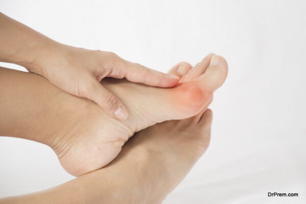 Common Causes of Bunions